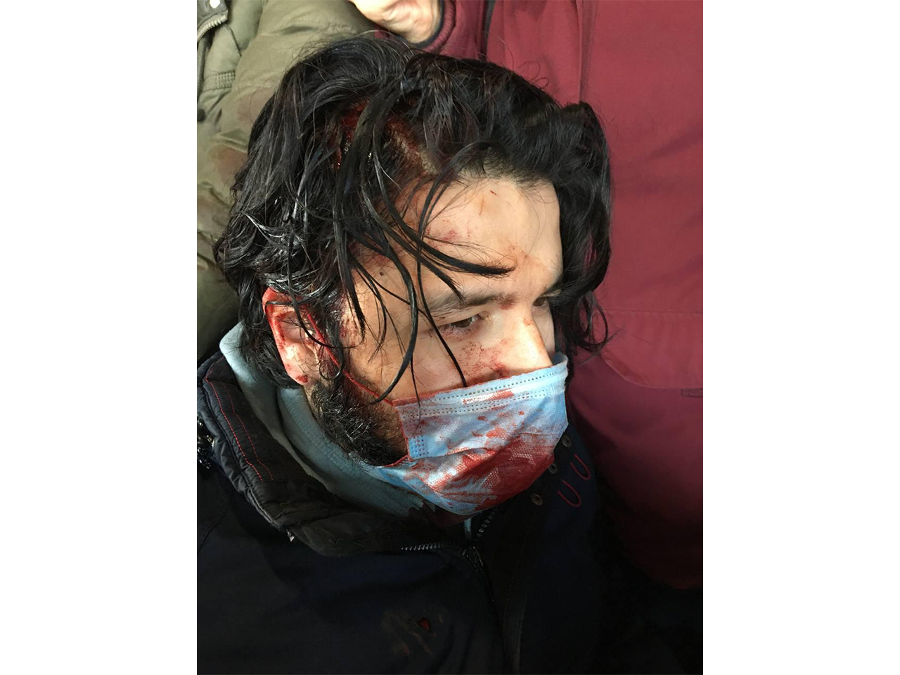 Shukhrat Shiroliev's head was smashed during detention. According to him, he was detained at the monument to Peter the Great in St. Petersburg, knocked to the ground and beaten with police truncheons. March 6, 2022 / Photo provided by other detainees